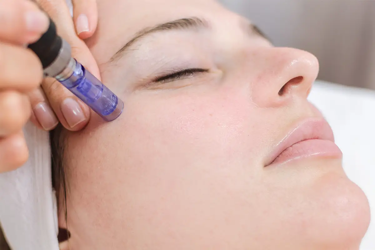Microneedling by Forever Beauty Spa In Salt Lake city UT